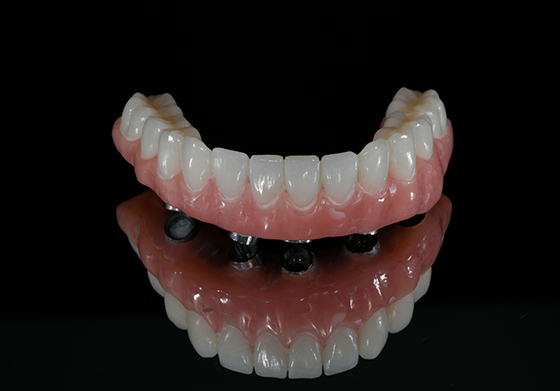 Hybrid Bar Denture