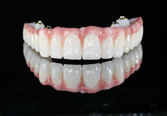 Implant Screw Retained Full Mouth Bridge